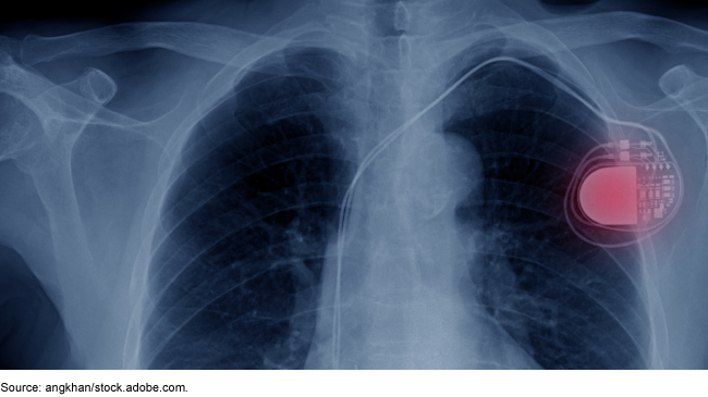 X-ray image of an implanted cardiac pacemaker in the chest area.